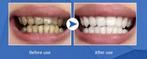 KIT de Blanchiment Dentaire Professionnel, Nieuw, Overige typen, Ophalen of Verzenden
