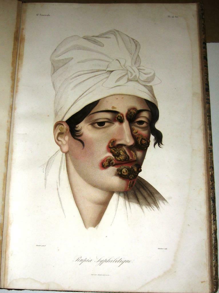 Les Maladies de la Peau 1856 Cazenave Dermatologie 60 platen, Ophalen of Verzenden