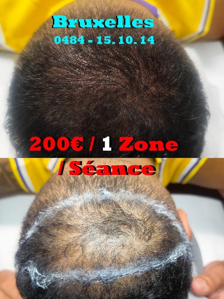 ✨ Micropigmentation capillaire à Bruxelles ✨, Services & Professionnels, Autres massages