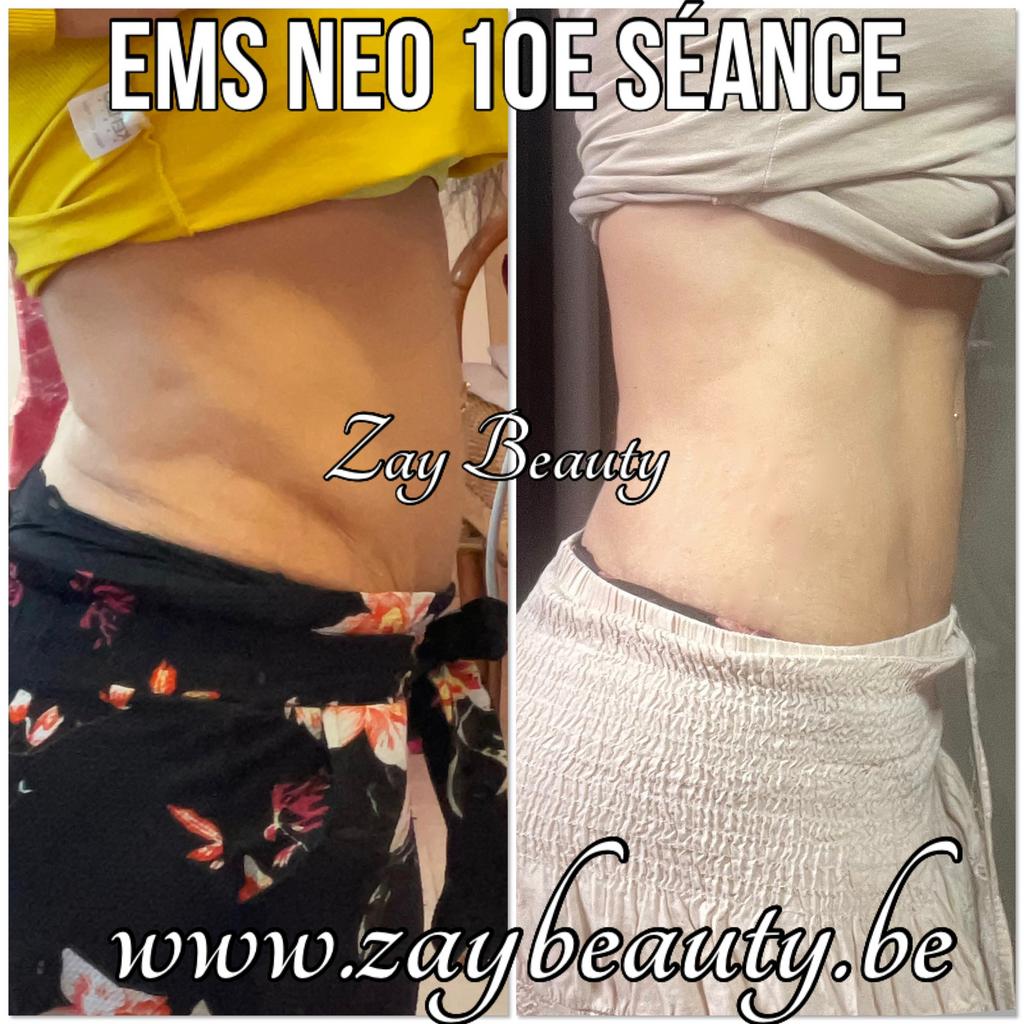 Ems Neo ems emsculpt, Ophalen