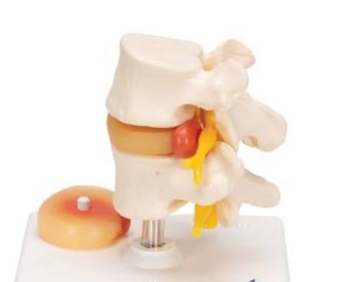 2 vertèbres lombaires avec prolapsus discal - marque 3M, Zo goed als nieuw