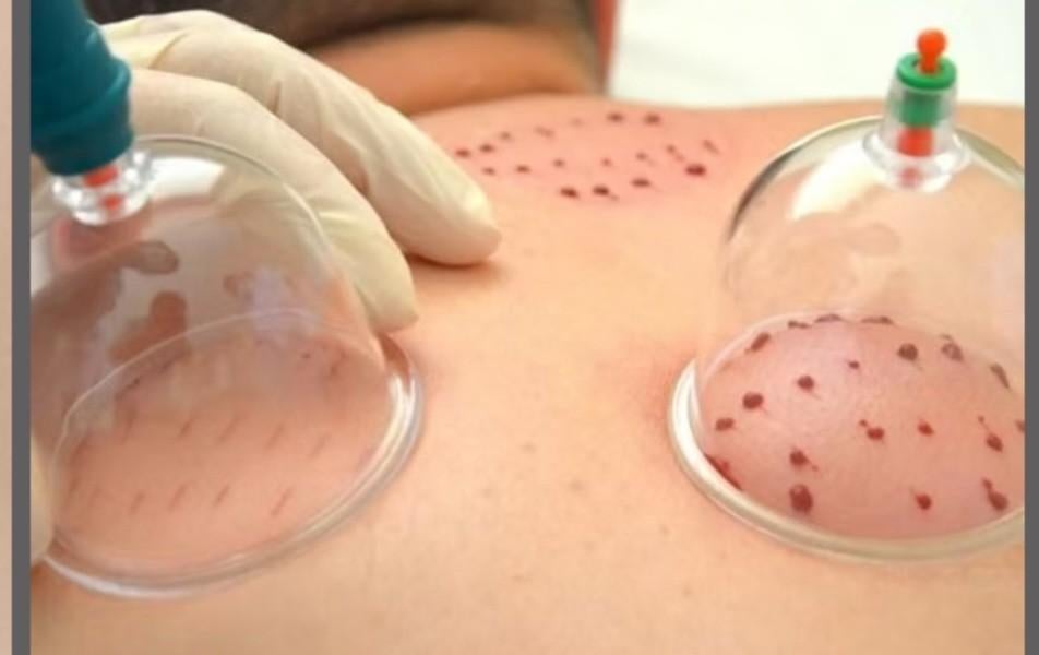 Hijama cupping thérapie pour femmes à domicile