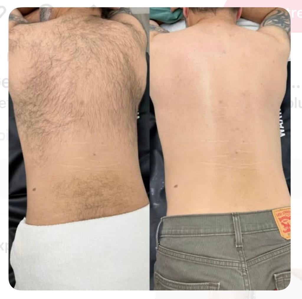 Épilation laser Homme, Enlèvement