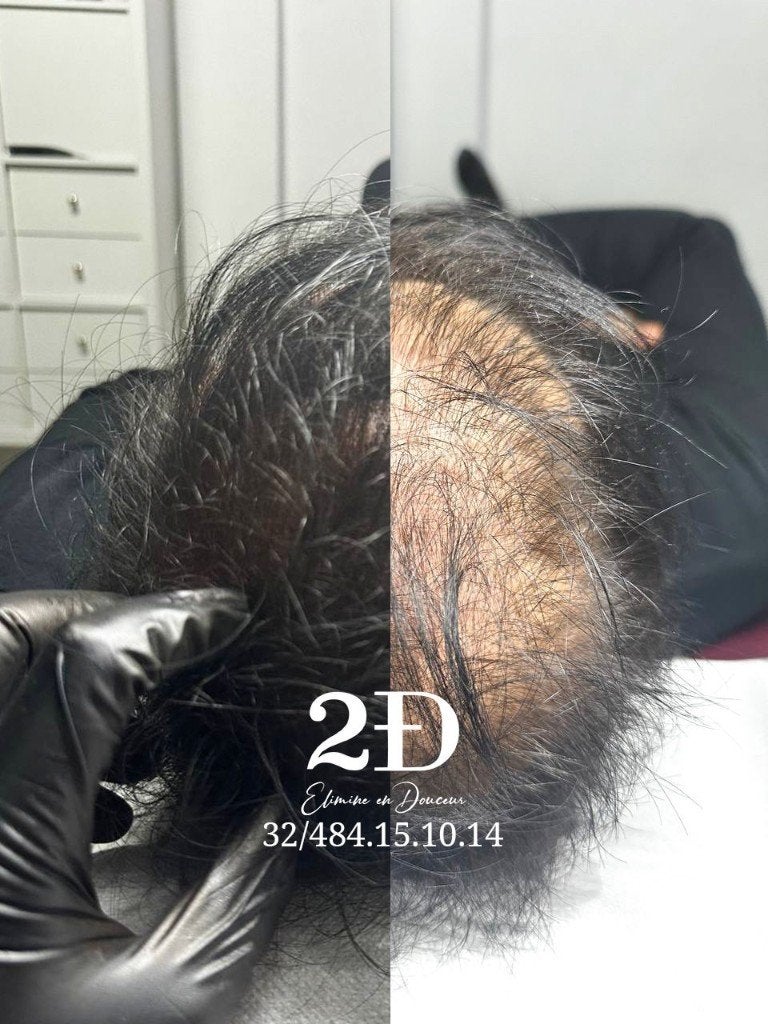 MicroPigmentation capillaire à bruxelles, Enlèvement, Neuf, Perruque ou Extension de cheveux