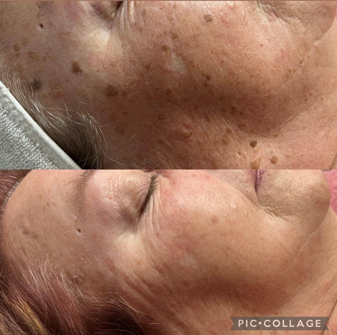 Alpha sparkpro diode laser en ipl, Ophalen