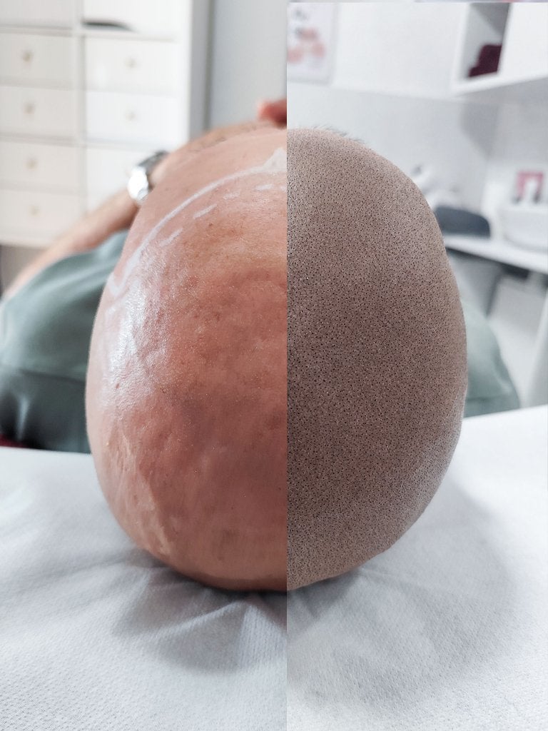 Dermopigmentation capillaire à Bruxelles, Enlèvement, Neuf, Perruque ou Extension de cheveux
