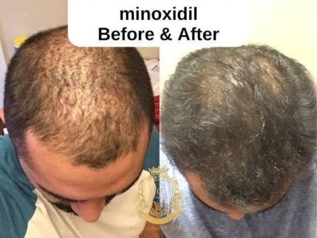 Minoxidil