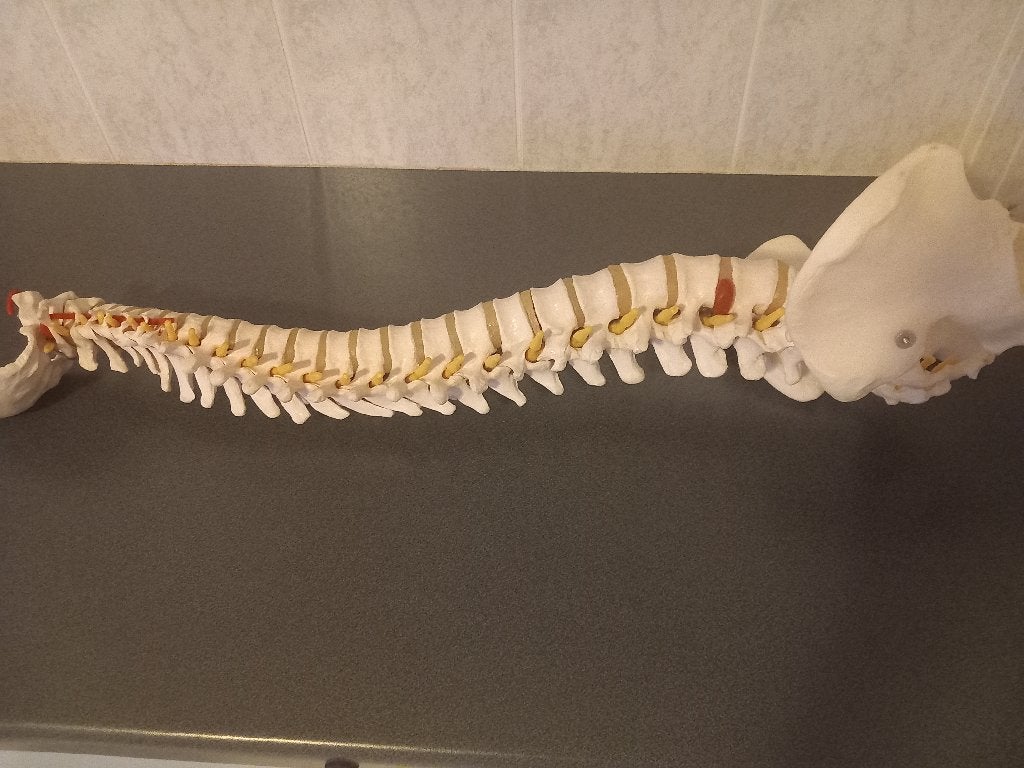 ruggegraat met Discus Hernia, Verzenden, Nieuw, Meerdere media, Persoonlijke verzorging
