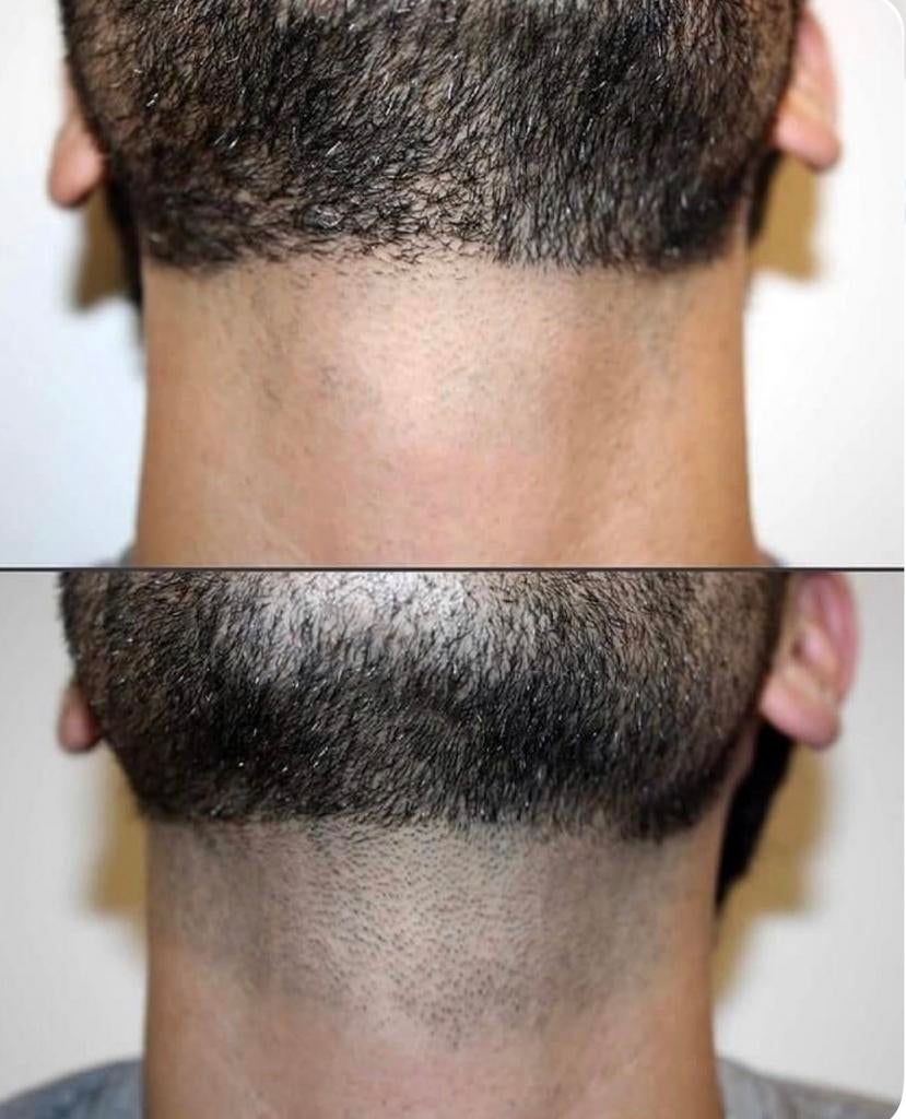 Épilation laser Homme, Enlèvement