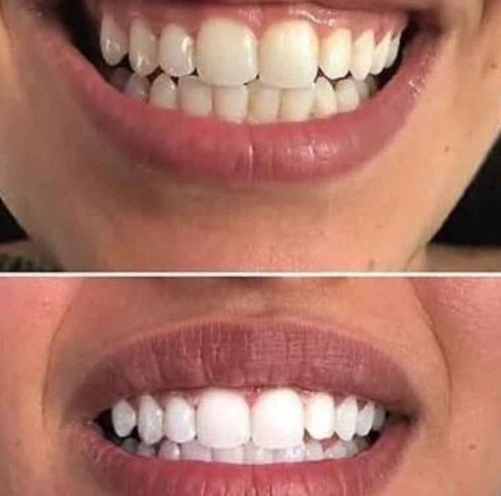 Blanchiment dentaire  +32 466 25 64 99 uniquement avec rdv, Enlèvement, Neuf, Autres types