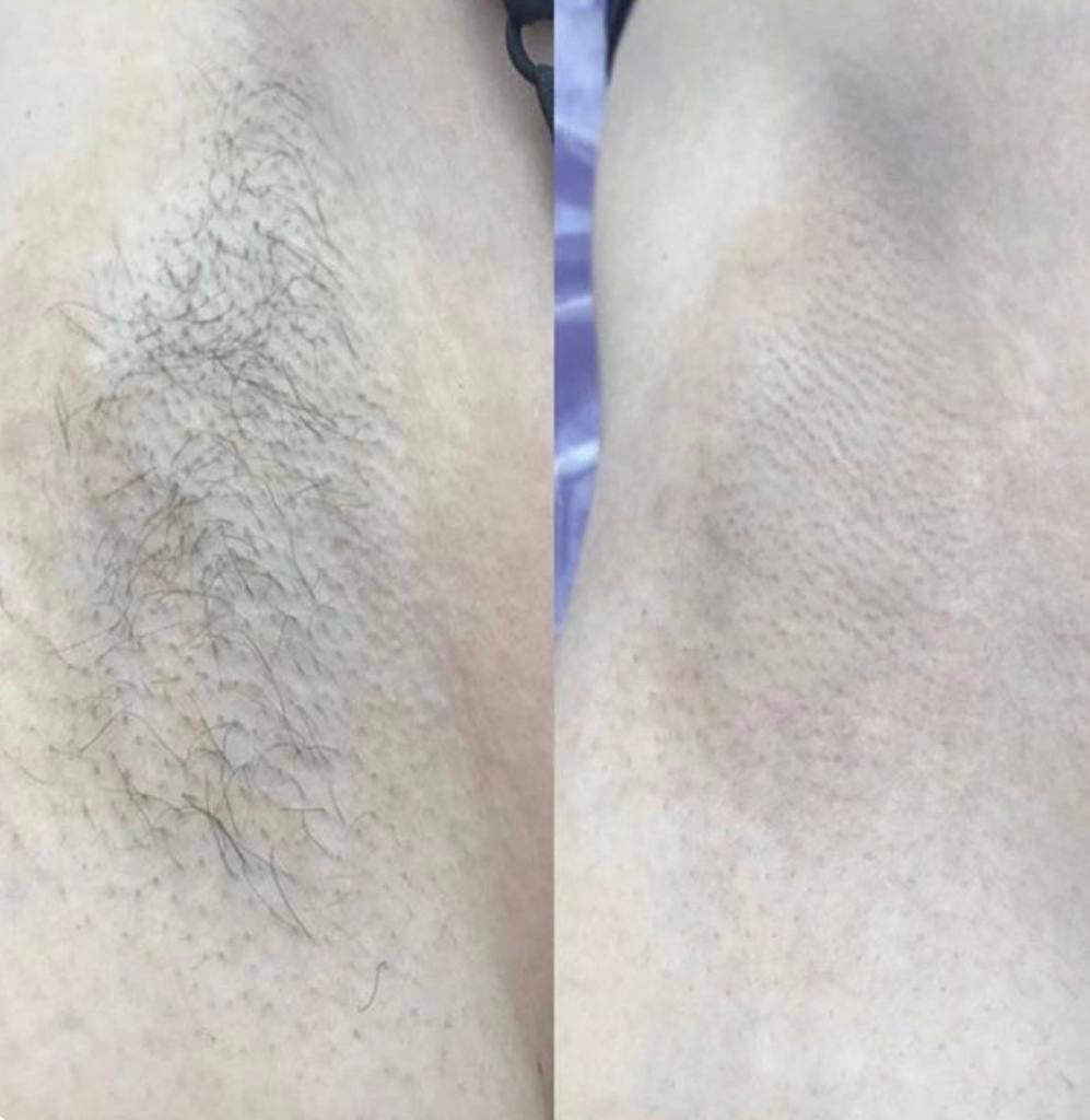 Épilation laser Homme, Enlèvement