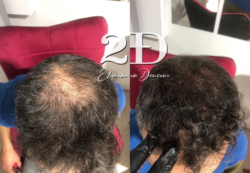 MicroPigmentation capillaire à Bruxelles, Enlèvement, Neuf, Tondeuse