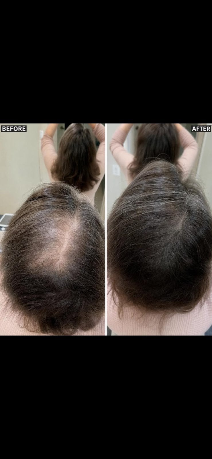 Minoxidil 6x – Complete doos met 6 potjes, Bijoux, Sacs & Beauté, Enlèvement ou Envoi, Neuf