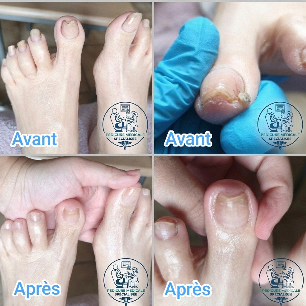 Soin Pédicure Médicale à domicile, Enlèvement, Neuf, Autres types