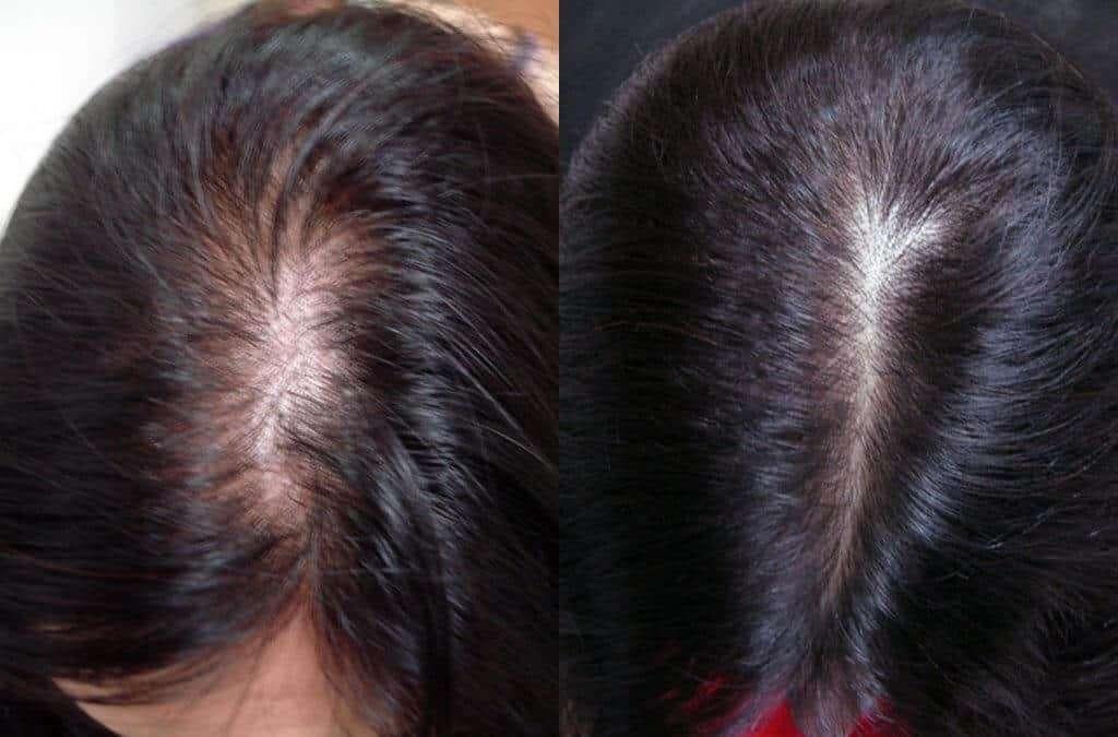 haar mesotherapie, Enlèvement, Neuf