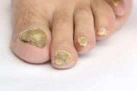 Medische pedicure/manicure kan beide met gellak Lochristi, Ophalen, Nieuw