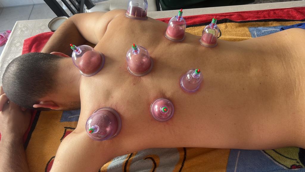 الحجامة النبويةHijama