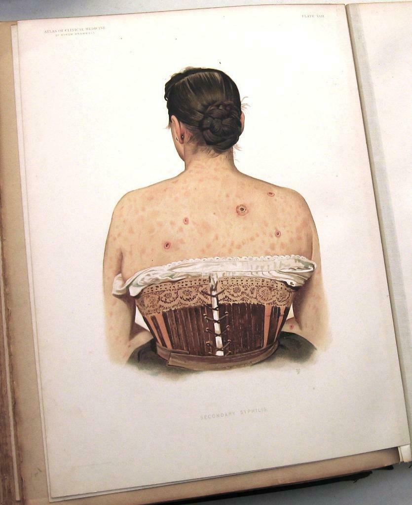 Atlas of Clinical Medicine Vol. 1&2 1892-3 Bramwell Medisch, Ophalen of Verzenden