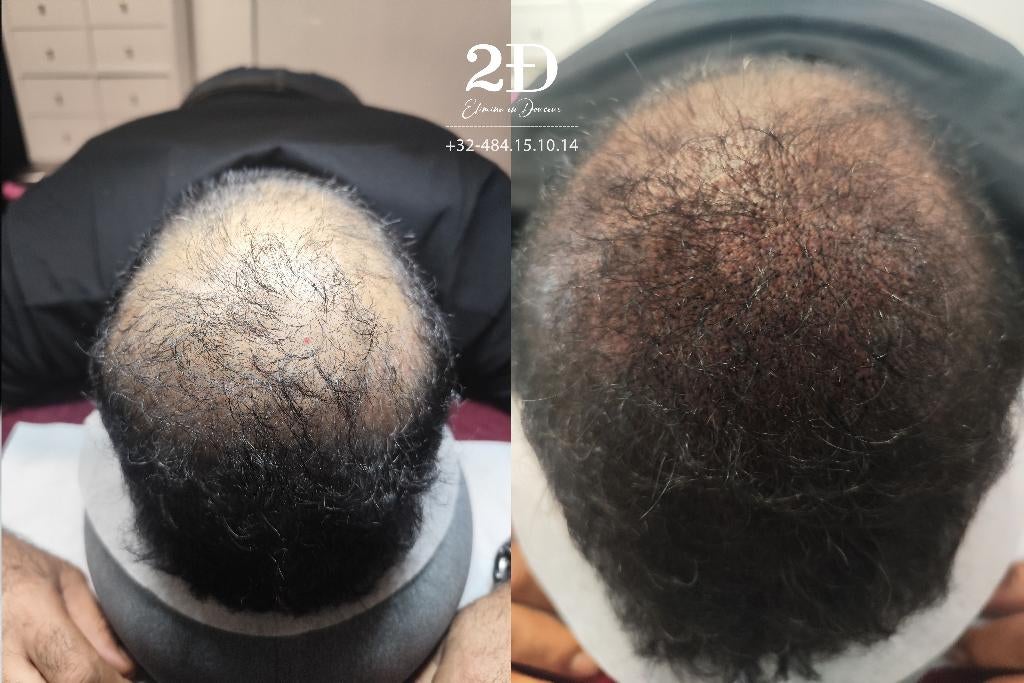 Dermopigmentation capillaire à Bruxelles, Bijoux, Sacs & Beauté, Beauté | Soins des cheveux, Enlèvement, Neuf, Perruque ou Extension de cheveux