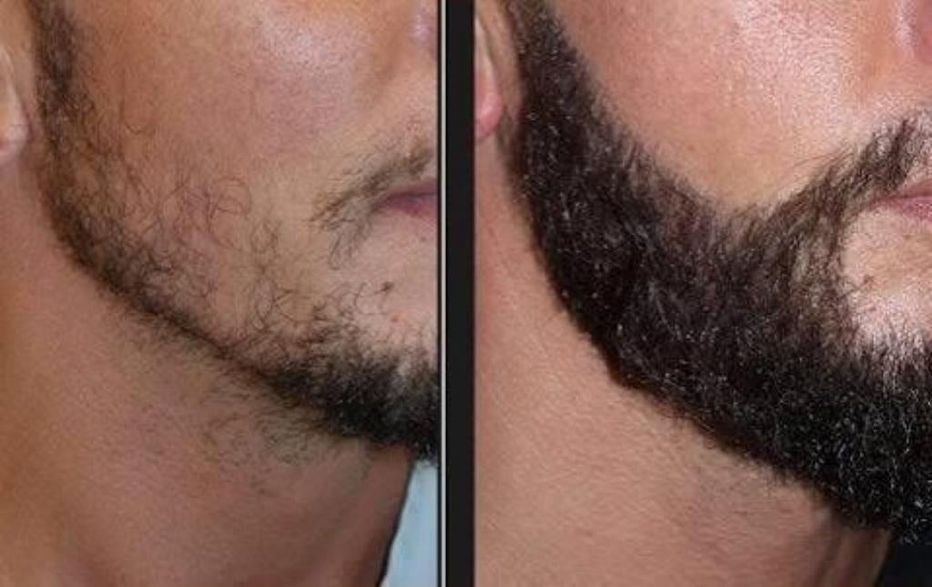 Minoxidil 5%, Enlèvement, Comme neuf