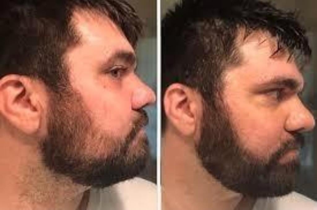 Minoxidil 5%, Enlèvement
