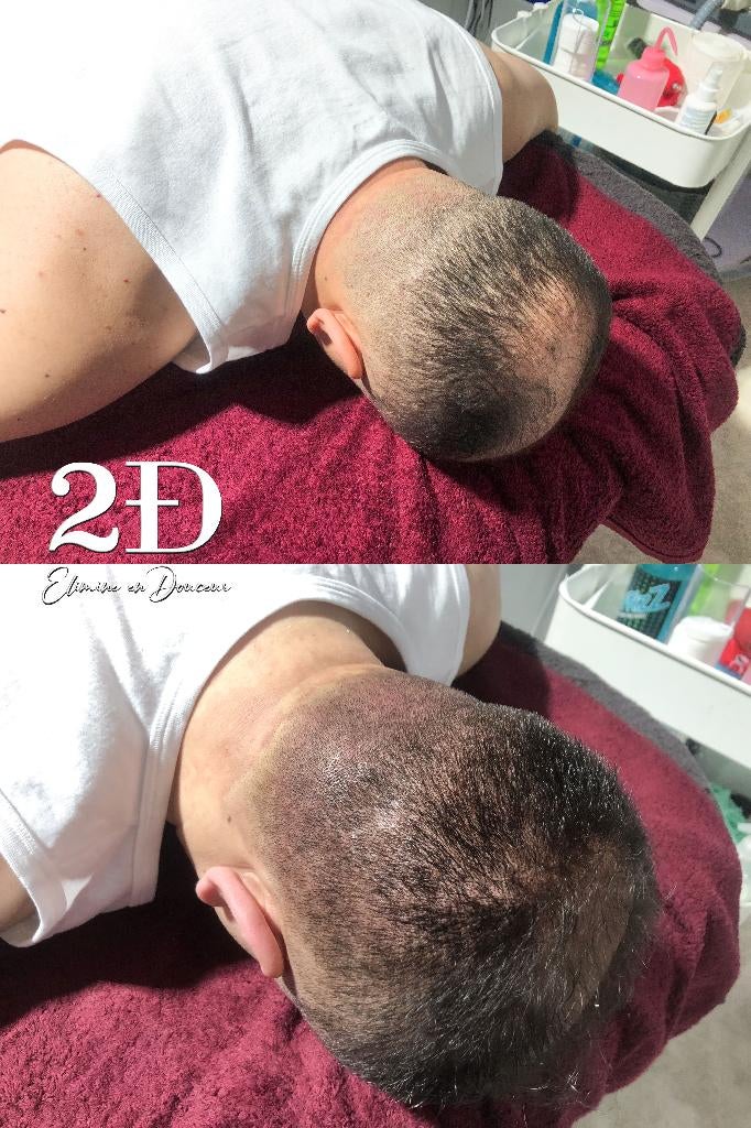 ✨ Micropigmentation capillaire à Bruxelles ✨, Services & Professionnels, Autres massages
