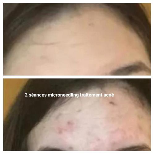 Microneedling, Bijoux, Sacs & Beauté, Beauté | Soins du visage