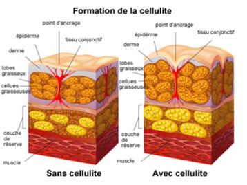 Endermologie anti cellulite dames