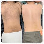 Épilation laser Homme, Handtassen en Accessoires, Ophalen