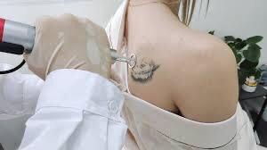 GRATIS tattoo verwijdering in ruil voor enkele uren tijd. beschikbaar voor biedingen