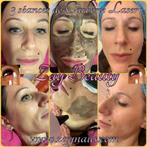Laser carbone Hollywood Peel, Zo goed als nieuw, Reiniging
