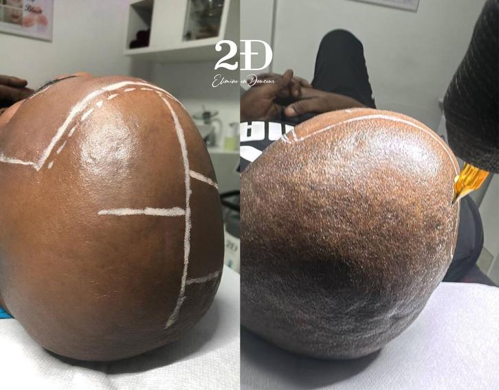 Capillaire micropigmentatie in Brussel, Handtassen en Accessoires, Uiterlijk | Haarverzorging, Nieuw, Haarverzorger of -hersteller