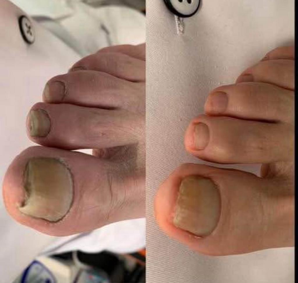 Medische pedicure te Berlare ook zondag, Ophalen, Nieuw, Overige typen