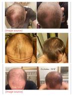 Minoxidil finasteride topical solution, Offres d'emploi