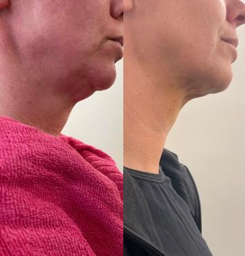 Cryolipolyse (vetbevriezing) MedCos Body-Wizard Duo beschikbaar voor biedingen