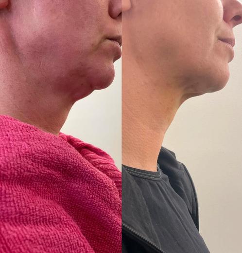 Cryolipolyse (vetbevriezing) MedCos Body-Wizard Duo, Diensten en Vakmensen, Welzijn | Masseurs en Massagesalons