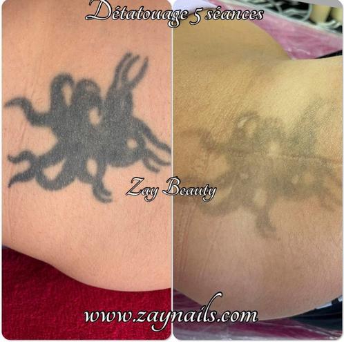 Détatouage au laser tattoo maquillage permanent Microblading, Bijoux, Sacs & Beauté, Beauté | Soins du visage, Comme neuf