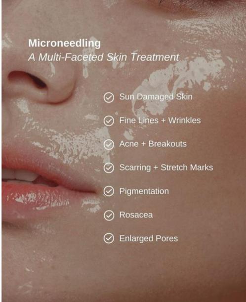 Gezichtsverzorging/microneedling behandeling, Diensten en Vakmensen, Schoonheidsspecialisten | Overige, Visagie