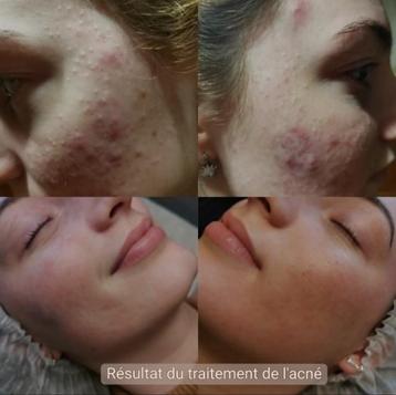 Traitement de l'acné/nettoyage mécanique du visage