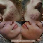 Traitement de l'acné/nettoyage mécanique du visage, Nettoyage, Enlèvement ou Envoi