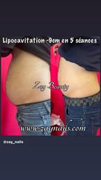 Lipocavitation alternative à la liposuccion, Bijoux, Sacs & Beauté, Beauté | Diététique & Perte de poids, Comme neuf