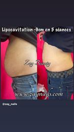 Lipocavitation alternative à la liposuccion, Comme neuf