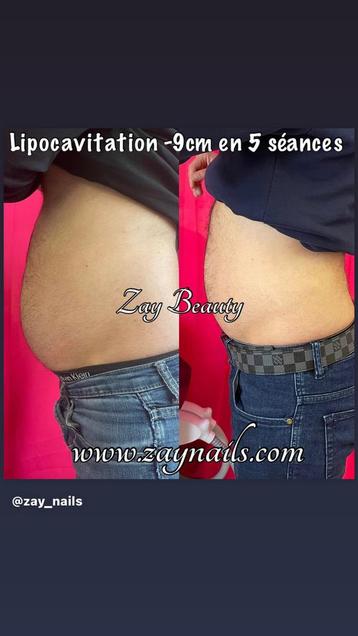 Lipocavitation alternative à la liposuccion  beschikbaar voor biedingen