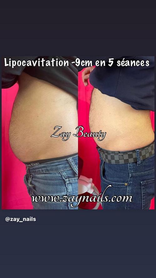 Lipocavitation alternative à la liposuccion, Handtassen en Accessoires, Uiterlijk | Dieet en Afvallen, Zo goed als nieuw