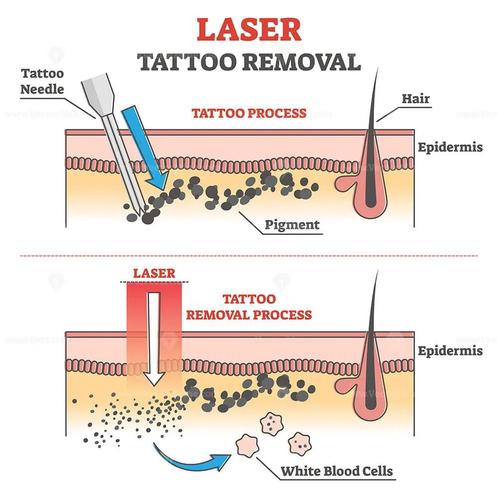 Spijt van uw tatoeage? Wij lossen het op., Sport en Fitness, Gezondheidsproducten en Wellness, Ophalen