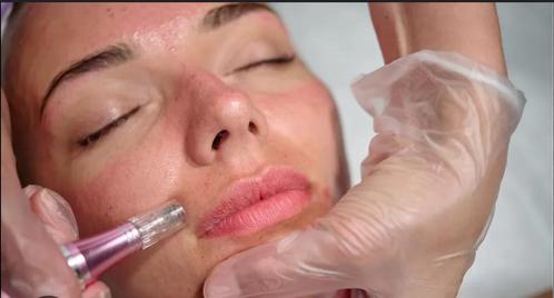Microneedling, Handtassen en Accessoires, Uiterlijk | Gezichtsverzorging, Zo goed als nieuw, Ophalen