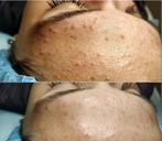 Traitement de l'acné/nettoyage mécanique du visage, Nettoyage, Enlèvement ou Envoi
