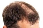Souffrant de perte de cheveux, Articles professionnels, Articles professionnels Autre, Envoi