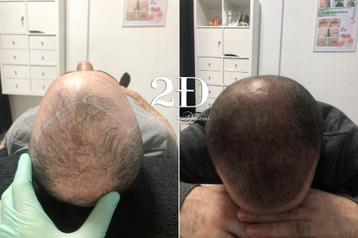 tricopigmentation et micropigmentation capillaire