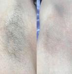 Épilation laser Homme, Handtassen en Accessoires, Ophalen